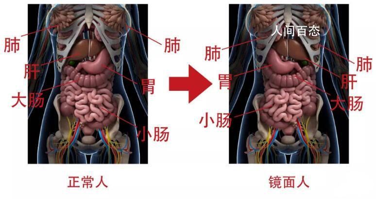 女子五脏六腑全部反着长 目前恢复良好已顺利出院(图1)